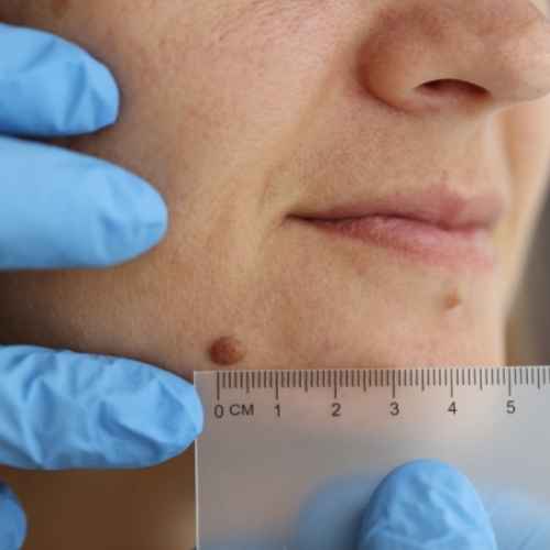 CryoPen Wokingham 	 - Blemish Removal