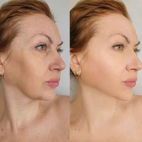 HIFU Non Surgical Facelift Wokingham 	
