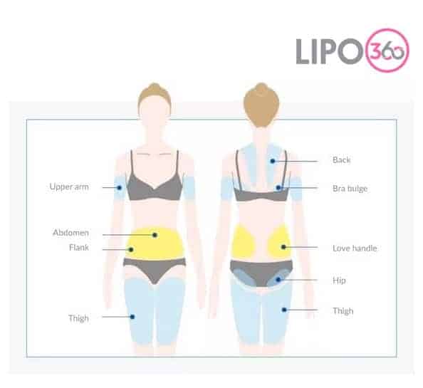 Various Areas of the Body We Treat with Cryolipolysis Wokingham 	