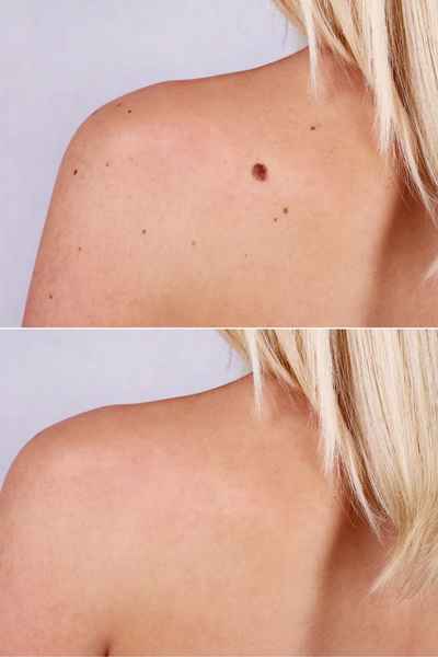 Why Does a Benign Mole Wokingham 	 Occur?