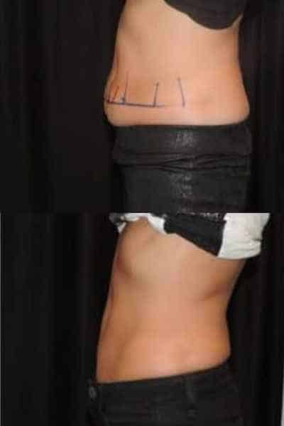 HIEMT Muscle Toning Wokingham 	