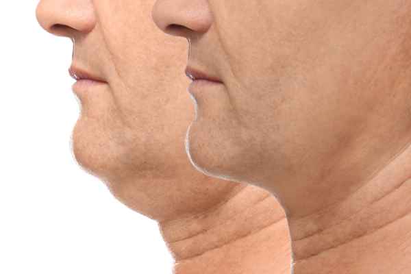 HIFU - Breakthrough in Anti - ageing 2 hifu results Wokingham