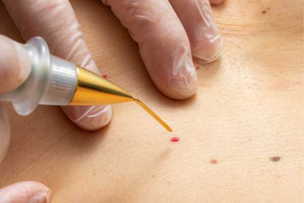 Dermatofibroma Removal Wokingham 	 - How We Remove It