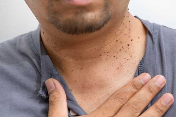 How Does Skin Tag Removal Wokingham 	 Work?
