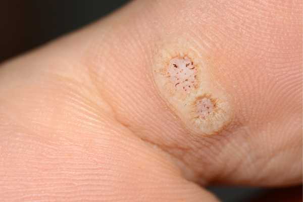 wart removal Wokingham 	
