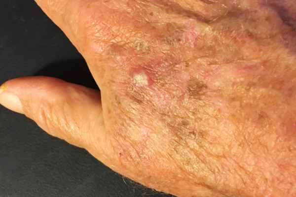 What Makes CryoPen a Safe Choice for Wart Removal Wokingham 	?