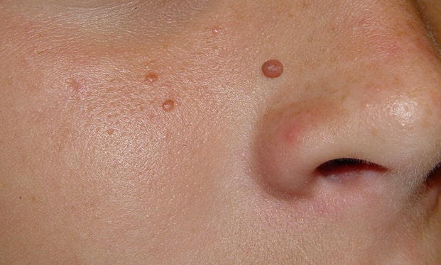 Angiofibromas Wokingham 	 Removal Treatment