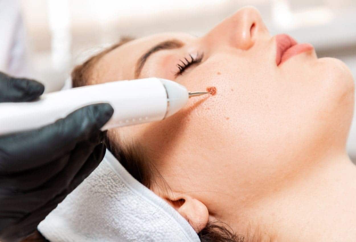 Benefits of Ephelides Treatment Wokingham 	