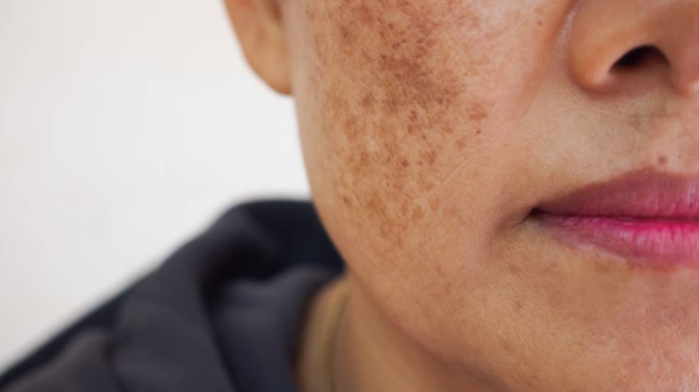 Ephelides Treatment Wokingham 	