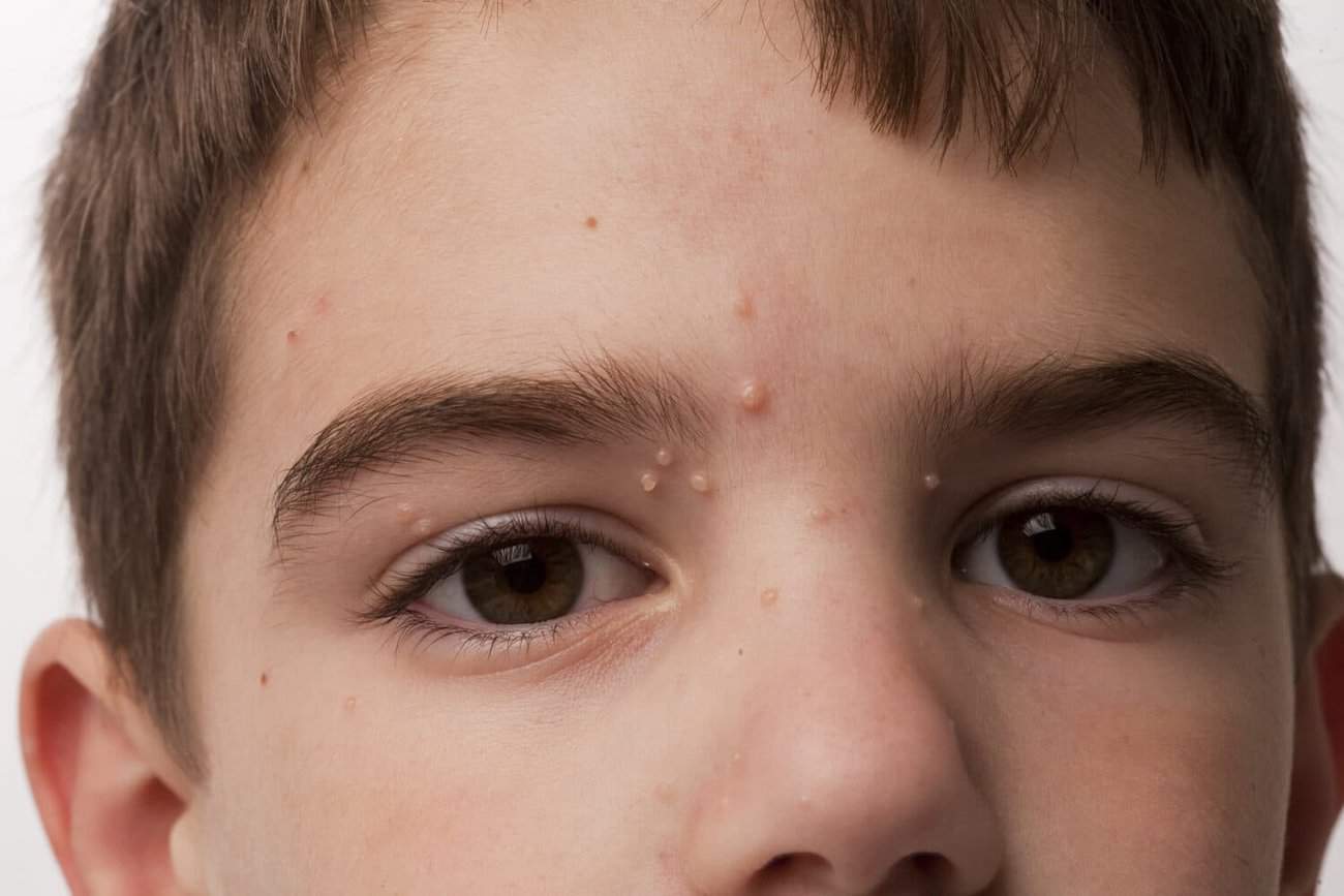 Molluscum Contagiosum Wokingham 	, How We Remove It