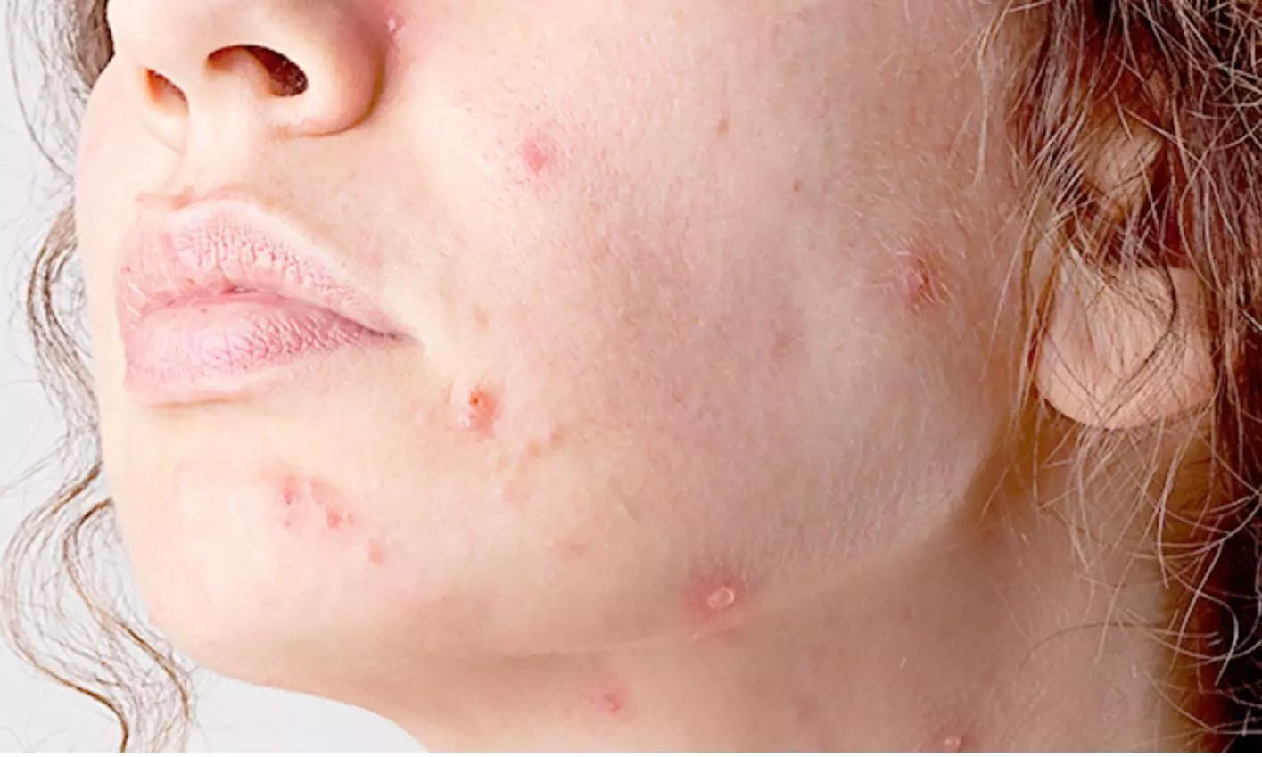 Porokeratosis Wokingham 	, How We Remove It