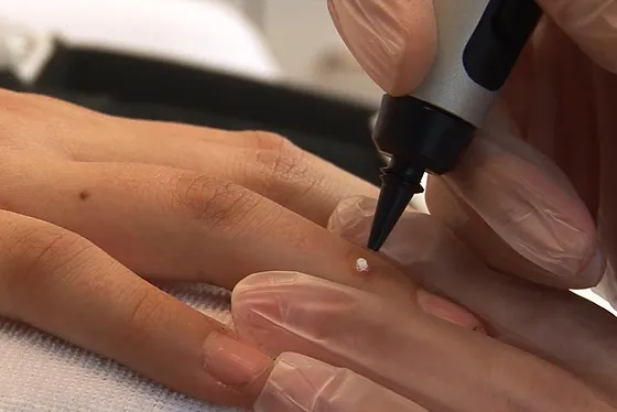 Porokeratosis Treatment Wokingham 	
