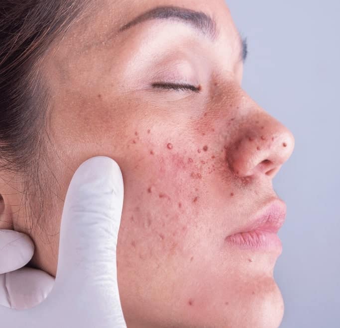 Angiofibroma Treatment Wokingham 	