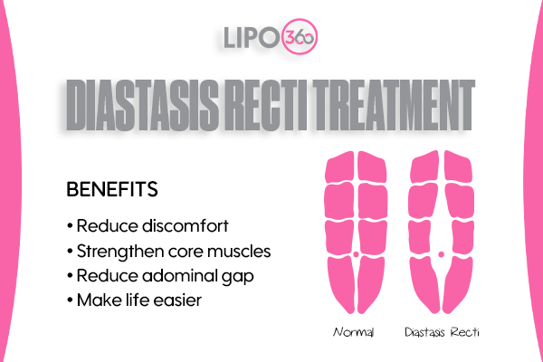 diastasis recti treatment