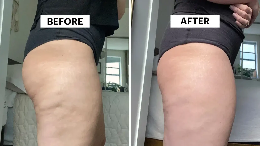 Sculpting Your Bum: Can Toning Exercises Really Reduce Cellulite? 1 Do Toning Exercise Wokingham Really Tackle Cellulite?