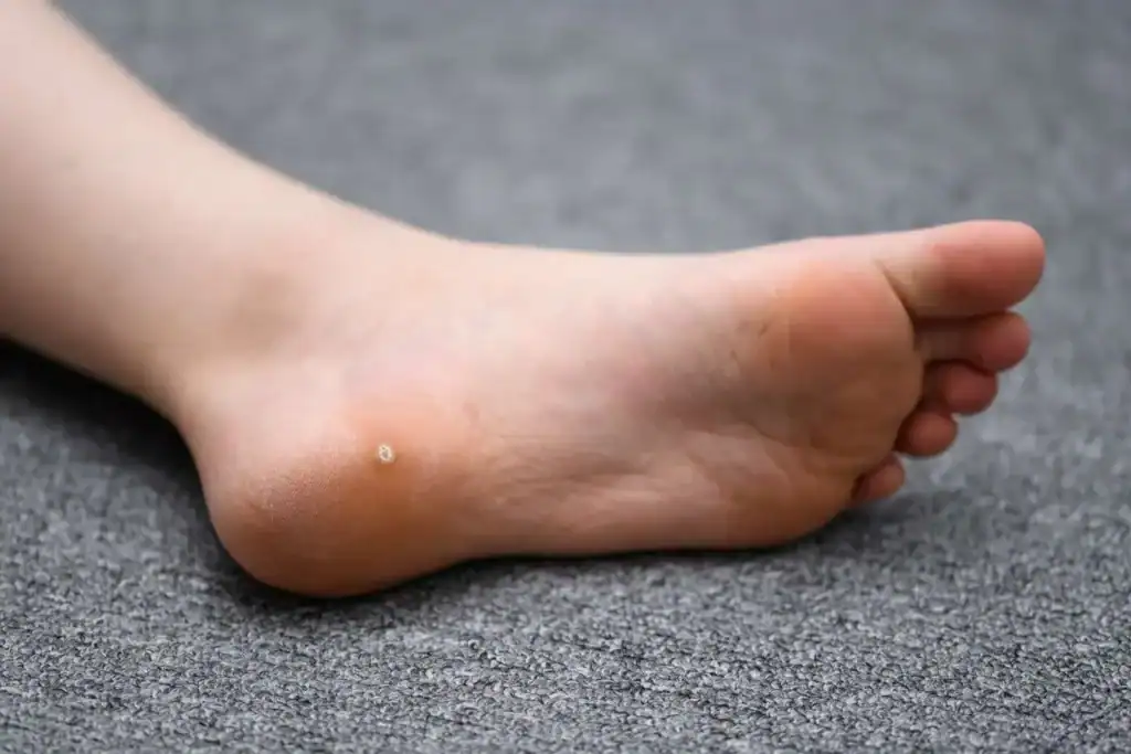 Image of verruca on the bottom of the foot that able to be treated with Cryotherapy Wokingham 	