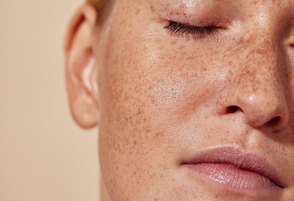 Why Is Lipo 360 Wokingham 	 the Right Place for Ephelides Treatment?