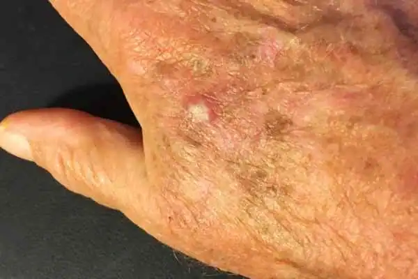 Cryopen For Actinic Keratoses 1 Image of Actinic keratoses Wokingham on a person hand