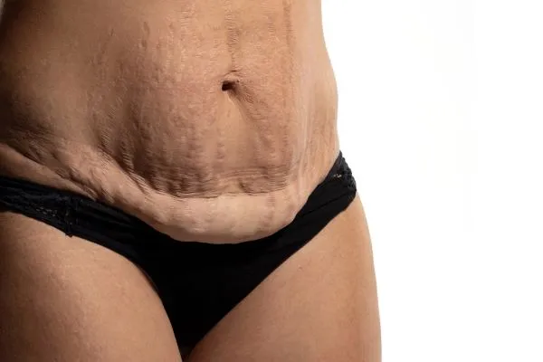 The Science of Skin Tightening 1 The science behind skin tightening Wokingham picture of a woman's sagging skin on the stomach
