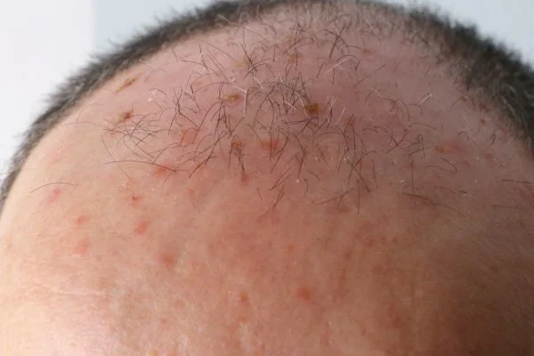 Actinic Keratoses Wokingham 	