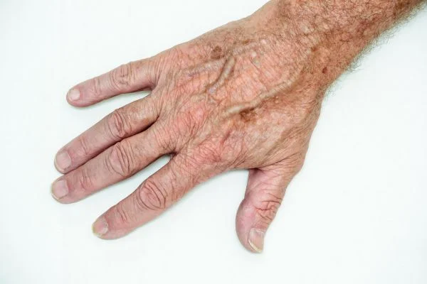 age spot removal Wokingham 	