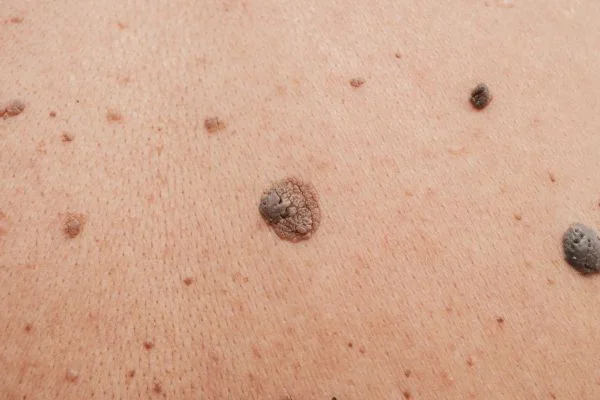 Benign Moles Wokingham 	