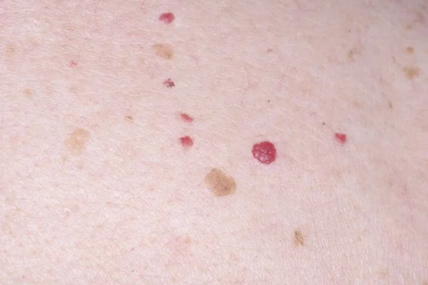 Cherry Angiomas Wokingham 	