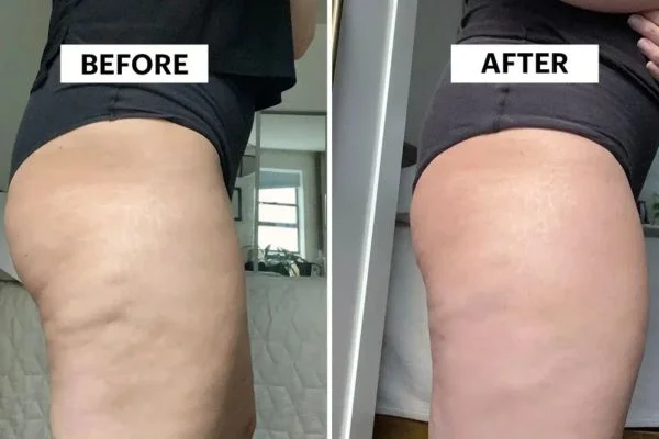 Body Sculpting Results Wokingham 	