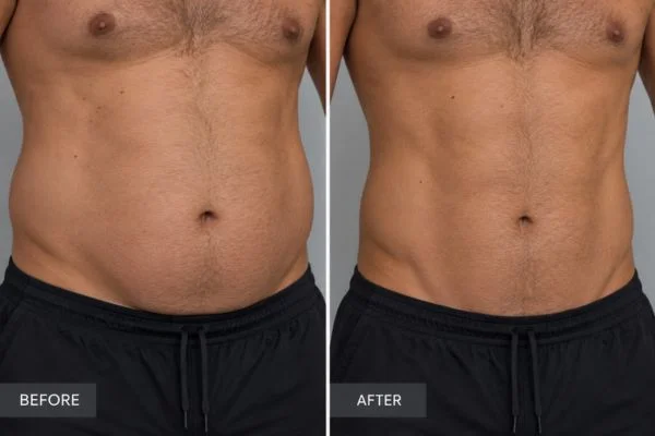 Body sculpting results Wokingham 	