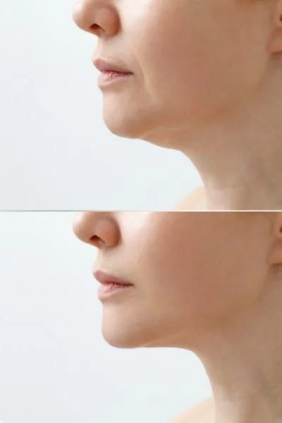 HIFU Before and after results Wokingham 	