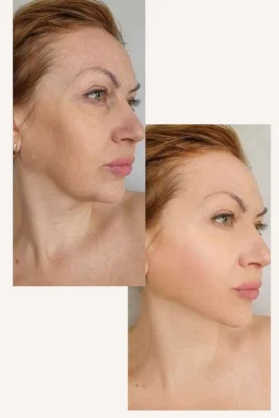 HIFU Results Wokingham 	 before and after