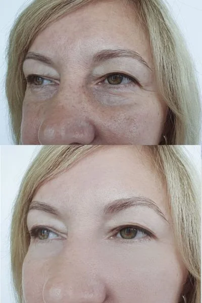 collagen lift 360 results Wokingham 	