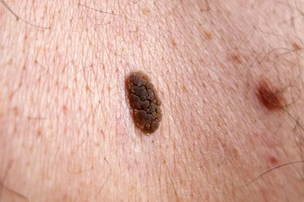 Seborrhoeic Keratoses removal Wokingham 	