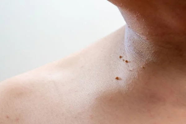 skin tag removal Wokingham 	