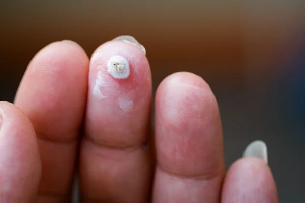 wart